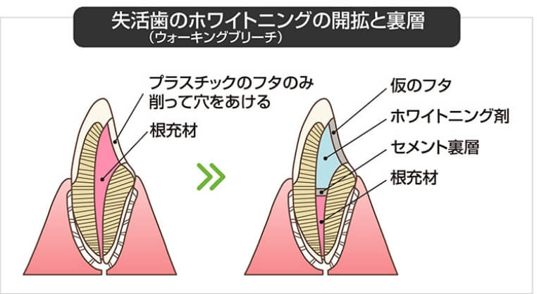 矢活歯のホワイトニングの開拡と裏層