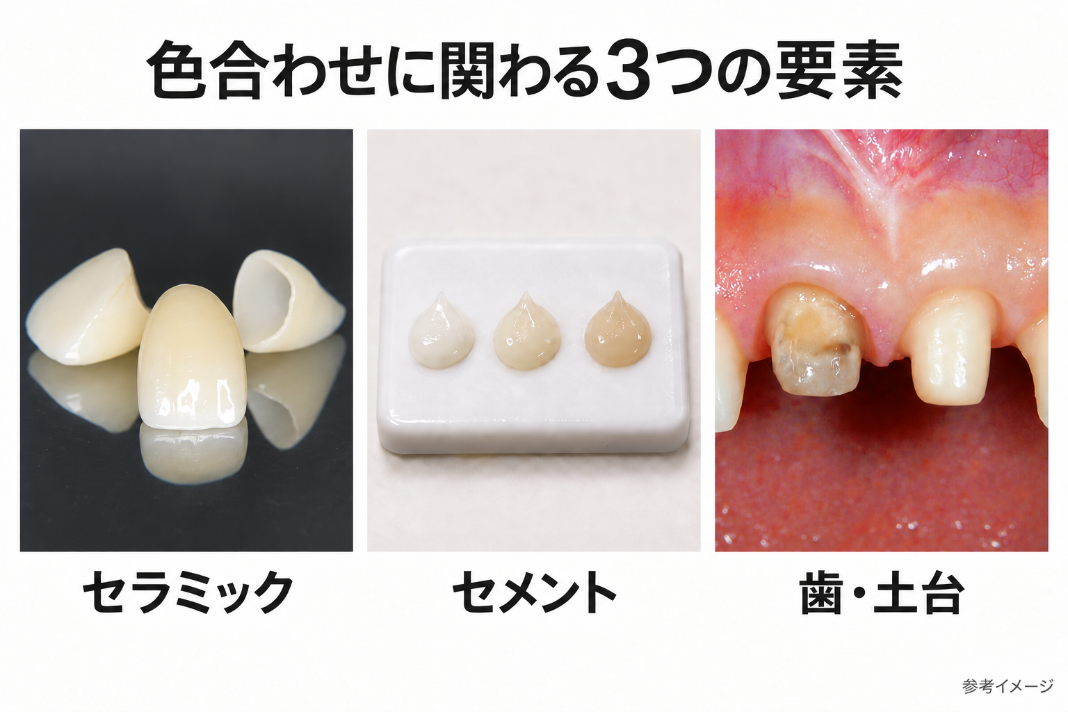 前歯用セラミック、3色のセメント、色調の異なる支台歯