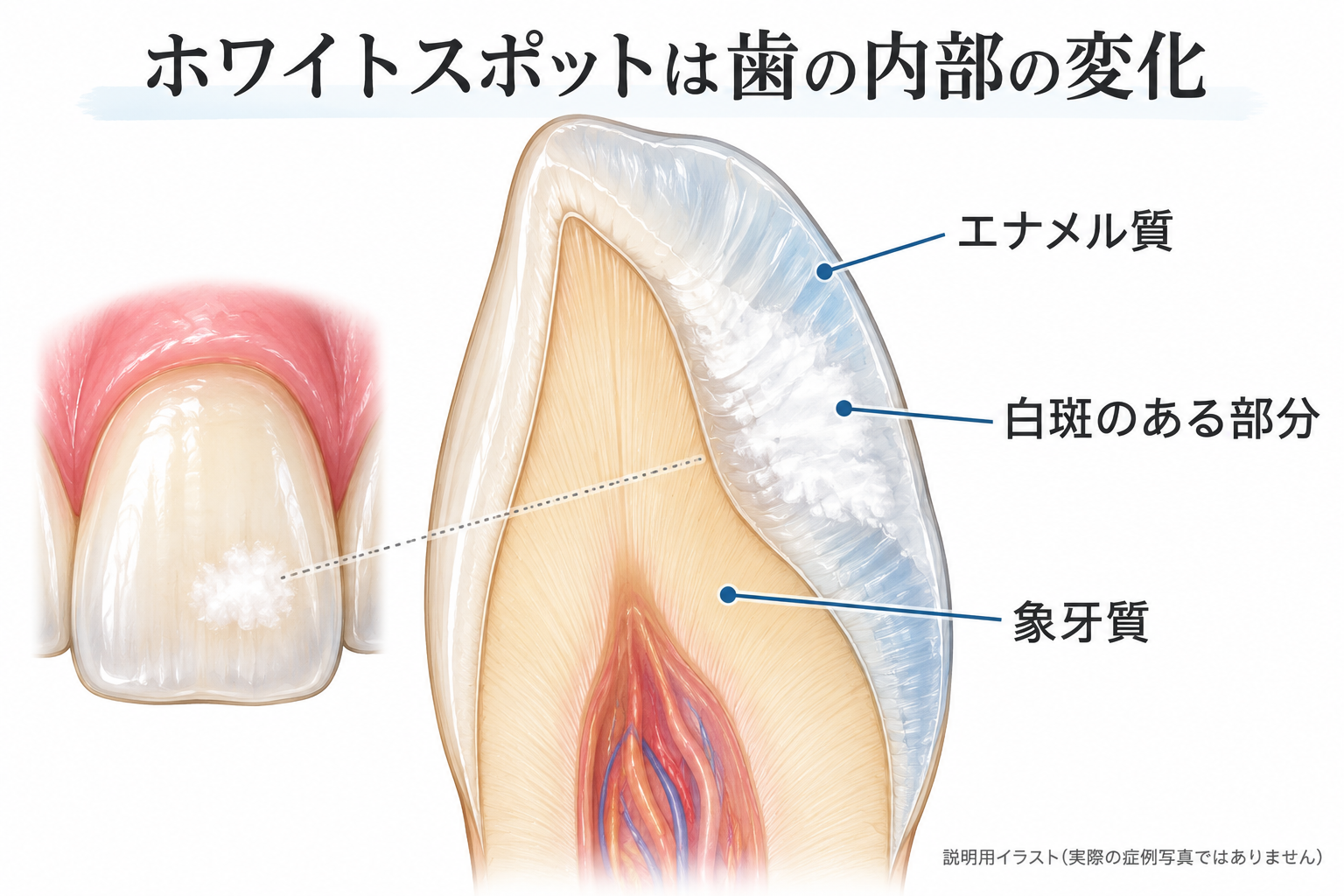 エナメル質内の白斑を示す説明図