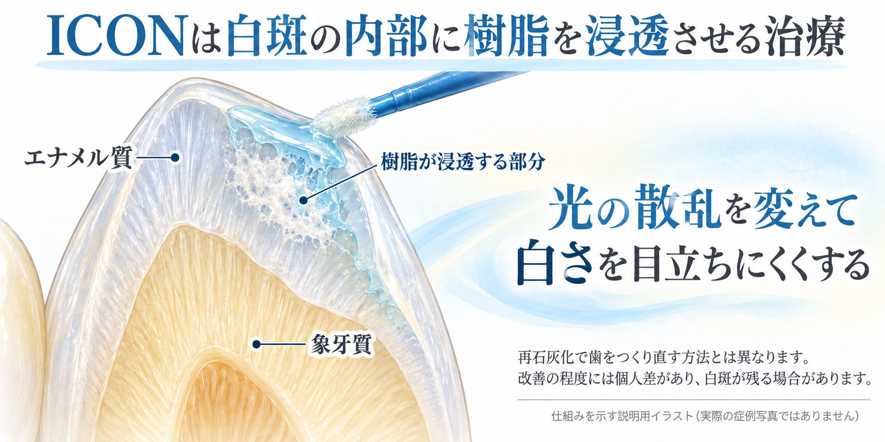 Iconの樹脂浸潤の仕組みを示す説明図