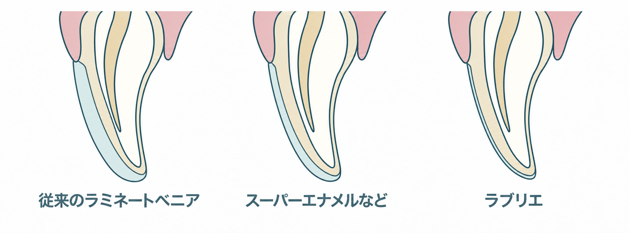 従来のラミネートベニアと削らないベニアの比較